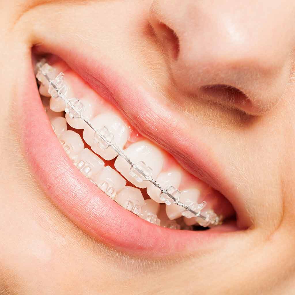 Quick, Discreet Treatment with Damon Clear Braces