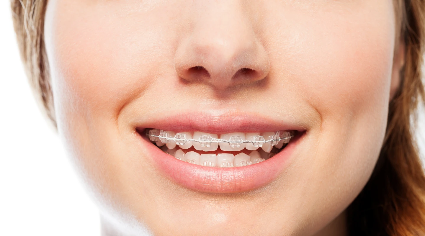 a girl with clear braces 2