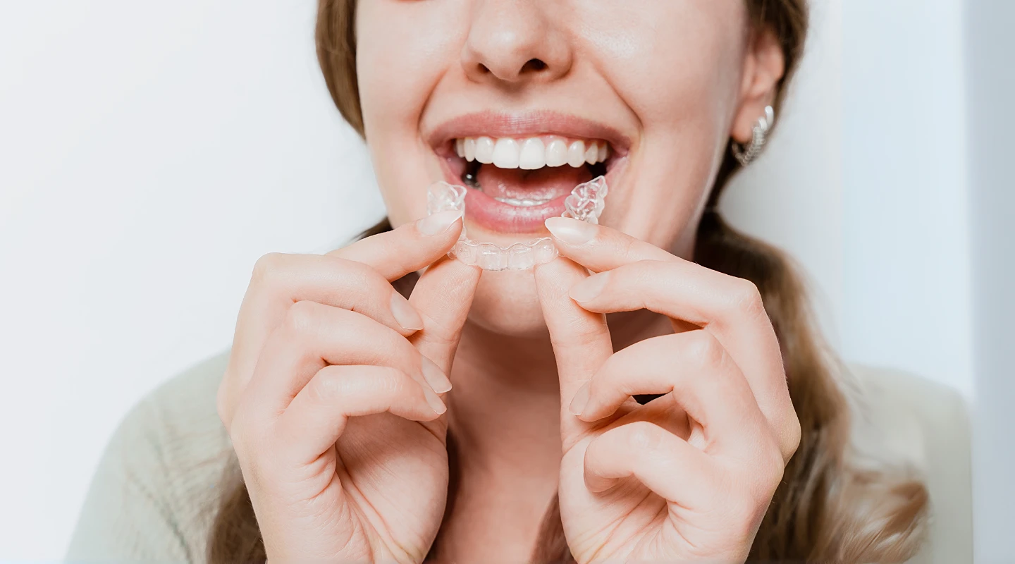 attaching clear aligners to teeth