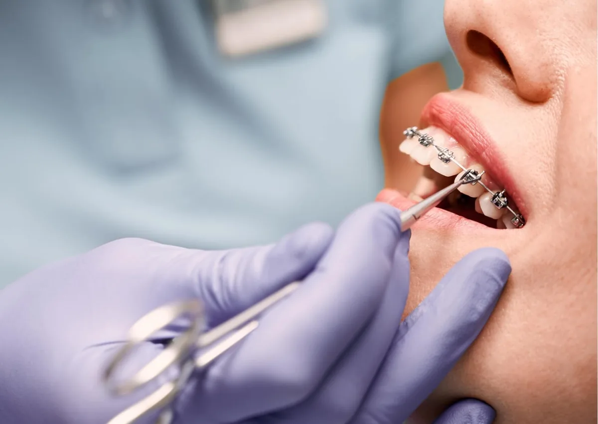 Orthodontist adjusting traditional metal braces during treatment.